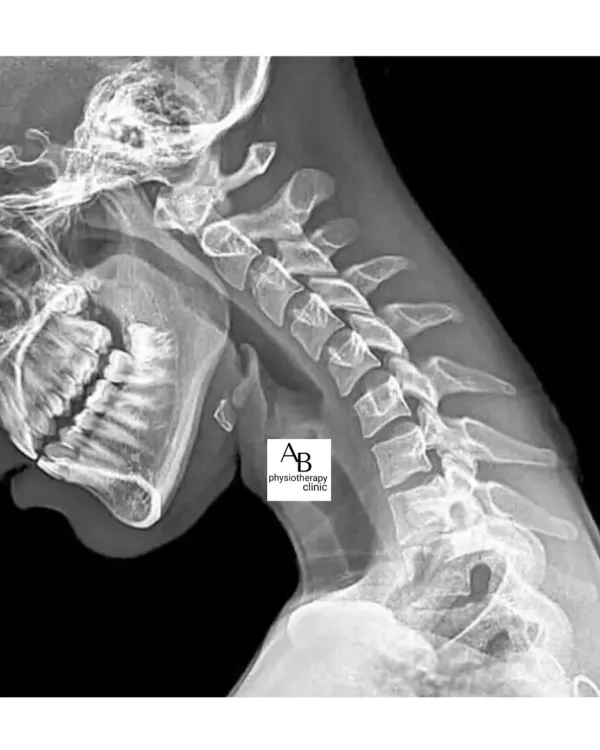 This is a cervical spine X-ray showing the effects of "Tech Neck." The constant forward head tilt from phone use puts immense pressure on your vertebrae, leading to pain, stiffness, and long-term degeneration.