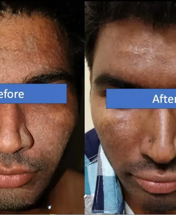 We believe in transformations you can see and feel. This client's journey with us resulted in a significant reduction in skin texture irregularities and pigmentation, revealing a clearer and more even complexion.