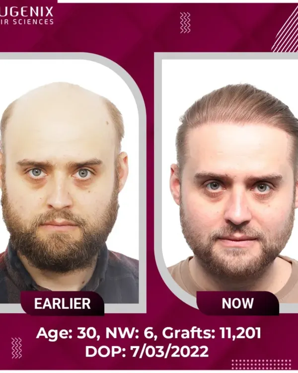 This is the power of doing it right, the first time. We transformed this patient's Grade 6 baldness with 11,201 grafts, restoring not just a full head of hair, but a youthful look that is completely natural. This is the standard of artistry we bring to every procedure.