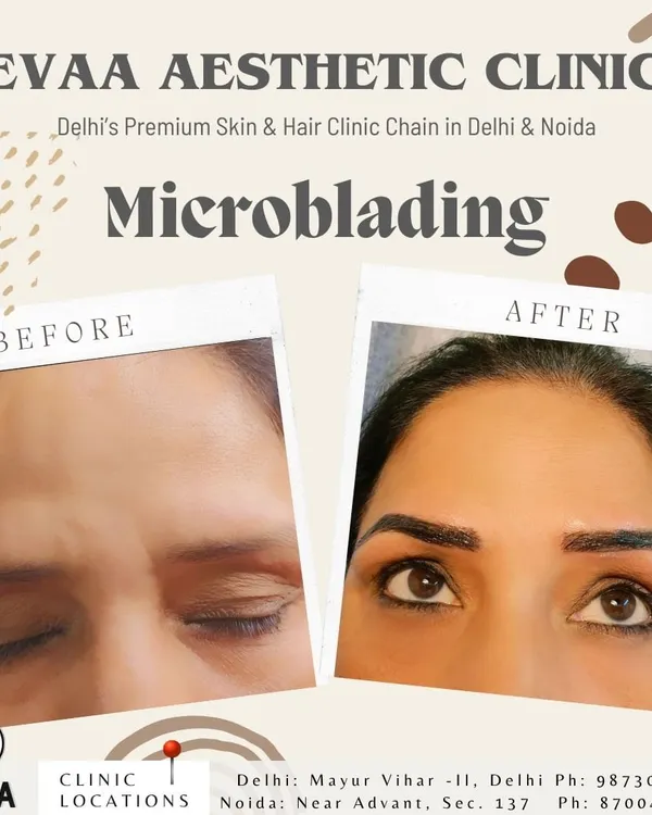 A clear before and after comparison showcasing the transformative effect of our microblading service. The client's brows are reshaped and filled, resulting in a fuller, more defined, yet natural appearance that enhances the entire face.