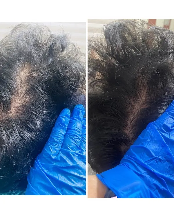 This is the kind of result we can achieve together. This patient saw a significant increase in hair density and scalp coverage after just three sessions of GFC therapy, a testament to a science-backed hair restoration plan.