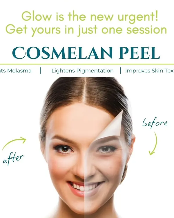 The Cosmelan Peel is one of my go-to treatments for effectively lightening pigmentation and treating melasma. This graphic shows how it works to reveal a brighter, more even complexion in just one session.