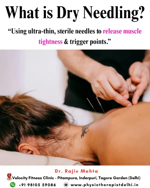 This image shows the application of Dry Needling, a technique where I use ultra-thin, sterile needles to target and release deep muscle tightness and trigger points, providing significant pain relief.