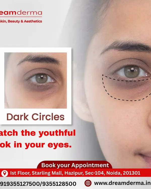 Dark circles can make you look perpetually tired. We help you catch the youthful look in your eyes again with advanced, tailored treatments designed to lighten pigmentation and restore freshness to the under-eye area.