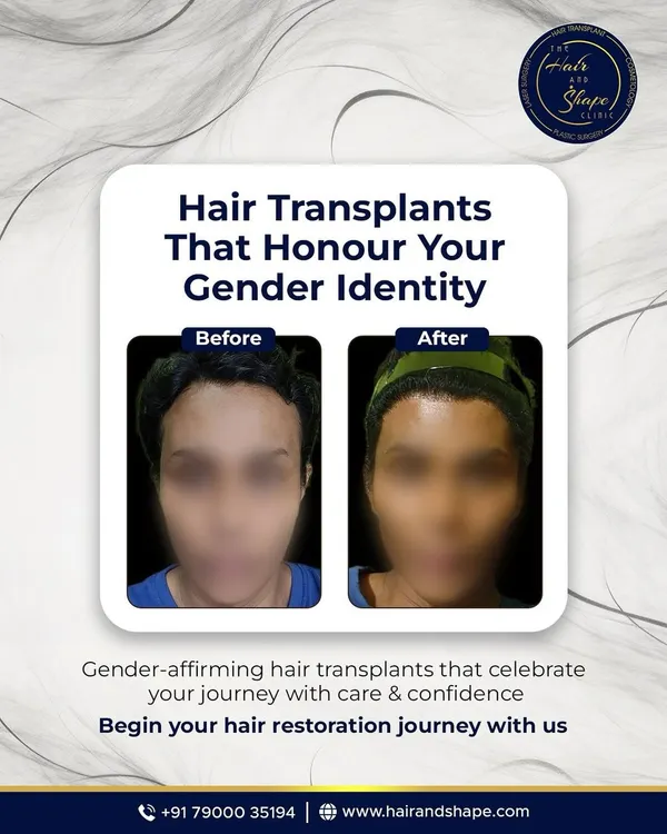 This is more than a before and after. It's about seeing yourself reflected in the mirror. We design hairlines that honour your gender identity, using your own hair to create a soft, feminine frame or a sharp, masculine one that feels completely natural.