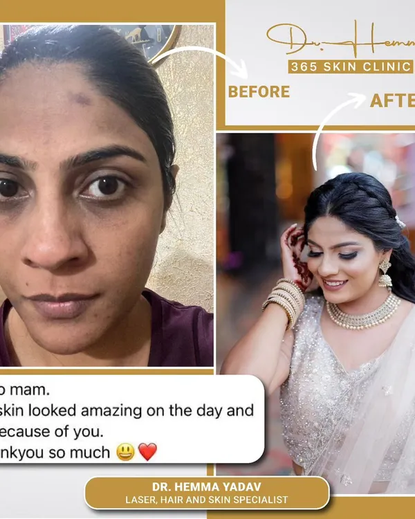 This is why I do what I do. This client came to me before her wedding, concerned about her skin tone and texture. We designed a personalized treatment plan, and the results on her special day speak for themselves. Achieving that clear, radiant skin is a process, and it's incredibly rewarding.