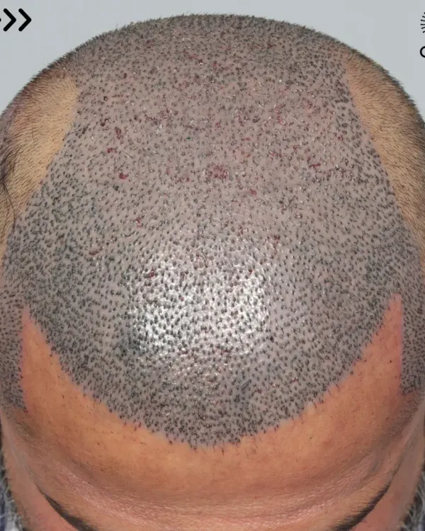 This patient came to us for a corrective hair transplant. We used 5500 grafts to recreate his hairline and re-densify the frontal part, mid-scalp, and crown.