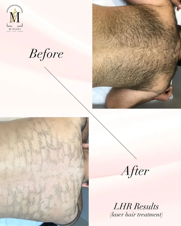 A powerful transformation for my male client. This before and after shows the results of laser hair treatment on the back, moving from dense hair growth to significantly smoother, clearer skin.
