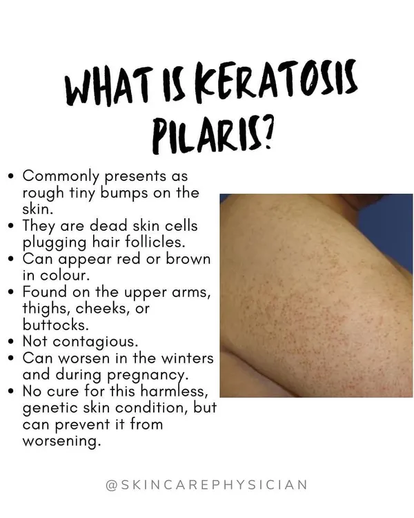 Keratosis Pilaris, often called 'chicken skin' or 'strawberry skin', presents as tiny, rough bumps on the upper arms, thighs, or cheeks. It's caused by dead skin cells plugging hair follicles.