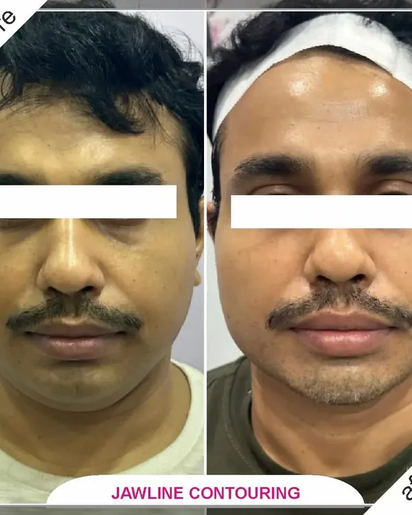 A defined jawline can significantly enhance facial harmony. This before and after showcases the results of non-surgical jawline contouring, creating a stronger, more sculpted, and confident profile for my male client.