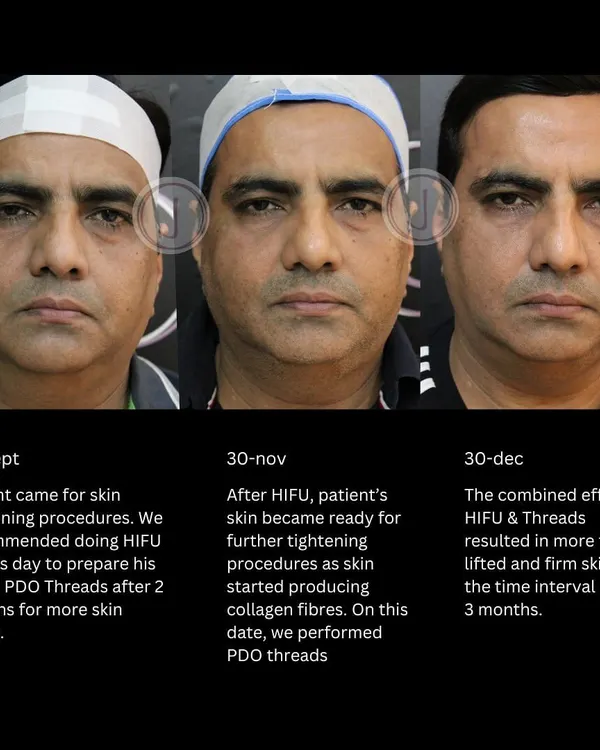 This is what a three-month journey to graceful aging looks like. We started with HIFU to build a strong collagen base, then used PDO threads two months later for a subtle lift. The result is firmer, tighter skin and a naturally refreshed appearance, not a changed one.