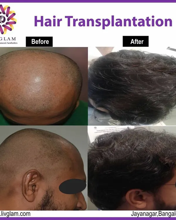 A life changing hair transplant result. This client went from significant baldness to a full, dense head of hair, completely restoring his hairline and confidence.