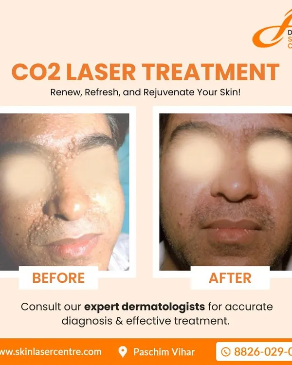 This before and after image shows the significant improvement possible with CO2 laser treatment. I used this precise laser to safely remove multiple growths from the patient's face, resulting in much smoother and clearer skin. This is a powerful tool for skin resurfacing.