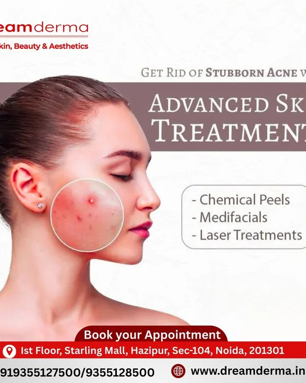 We tackle stubborn acne with a multi-pronged approach. Our advanced skin treatments include chemical peels for deep exfoliation, medifacials for healing hydration, and laser treatments to effectively target acne-causing bacteria and reduce scarring.