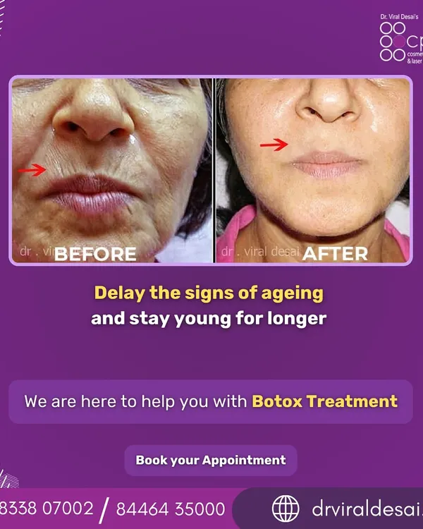 This is the result of a personalized anti-aging plan. My goal is to soften lines and restore a refreshed, natural look, not to alter your unique features. This transformation focuses on reducing prominent wrinkles around the mouth and nose for a smoother, more youthful appearance.