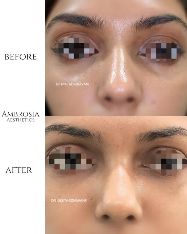 A clear before-and-after of our under-eye filler treatment. By carefully restoring lost volume in the tear trough area, we can instantly reduce the appearance of dark circles and hollowness.