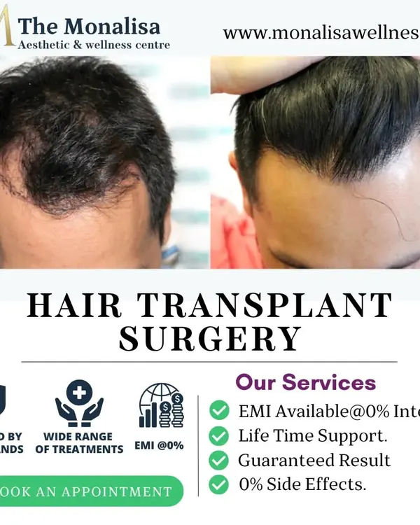This before and after comparison showcases the high-density results we achieve with our hair transplant surgery. We focus on restoring a natural hairline that complements your features.