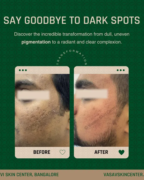 This image shows the significant reduction of deep acne scars and pigmentation on a patient's cheek after a personalized treatment plan. The 'after' photo reveals a much smoother skin texture and a more even skin tone, restoring clarity and confidence.
