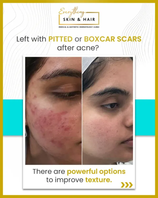 A powerful before-and-after example of how my customized treatment plans can significantly reduce the appearance of deep, pitted acne scars and restore skin confidence.
