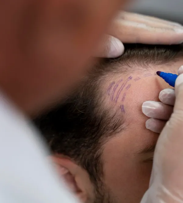 The first step in a successful hair transplant is meticulous planning. I personally design and mark out the recipient area to create a hairline that is age-appropriate and looks entirely natural. This ensures the transplanted hair blends seamlessly.