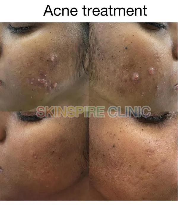 This before and after shows the result of a targeted acne treatment plan. Our first goal is always to reduce active flare-ups and prevent new ones from forming, which you can see in the clearer, calmer skin on the right.