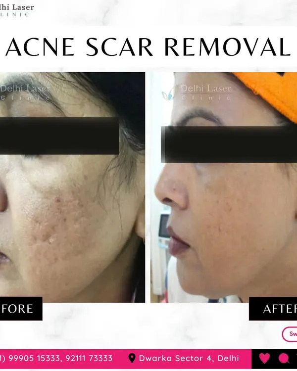 This is the kind of transformation possible for deep, pitted acne scars. Using advanced fractional laser technology, I work to resurface the skin, reduce scar depth, and improve overall texture for a much smoother appearance.