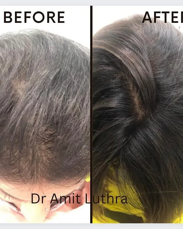 The results speak for themselves. This patient experienced amazing hair regrowth and increased volume after undergoing a course of my hair fall treatments.