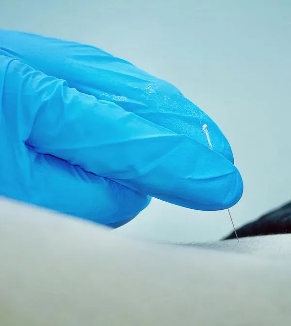 Dry needling is a precise technique we use to target and release tight muscle knots, or trigger points. A gloved therapist carefully inserts a fine needle to alleviate chronic pain and restore muscle function.