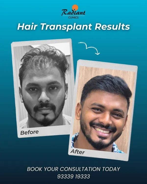 This is more than just a before and after. It's the story of renewed confidence. We achieved this natural, dense result by carefully transplanting follicles to recreate a youthful hairline that perfectly frames the face.