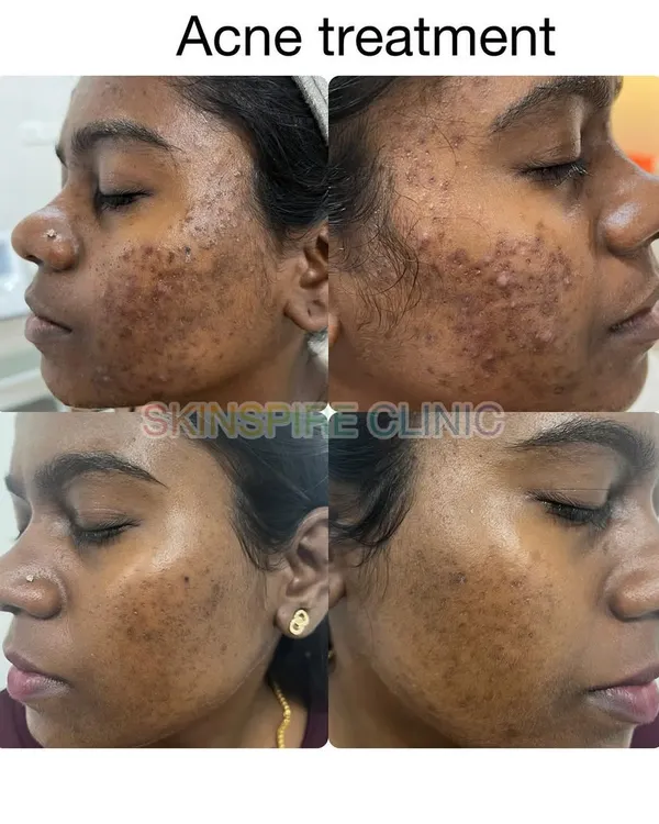 This before and after collage shows a significant reduction in active acne and post-inflammatory hyperpigmentation. Our treatment plan is designed to clear existing acne and prevent future breakouts for long term results.