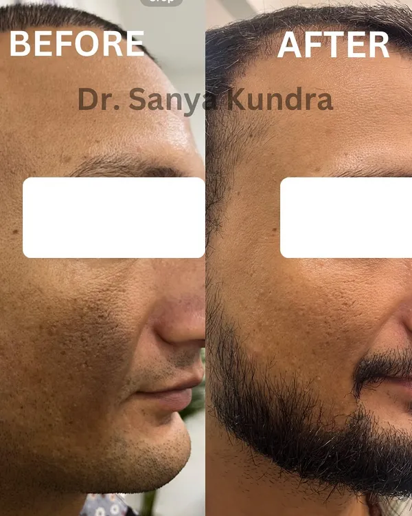 A remarkable before and after of a client's journey with us. This image shows a significant reduction in acne scars and improved skin texture after undergoing treatments like microneedling and PRP.