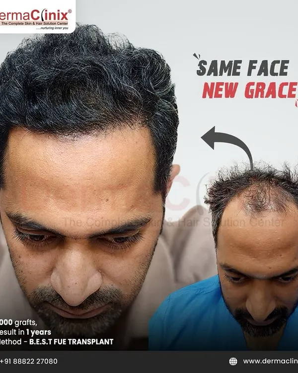 A before and after comparison showing a significant hair restoration. This image demonstrates the dramatic yet natural-looking results possible with my B.E.S.T. FUE transplant method, restoring not just hair but also confidence.