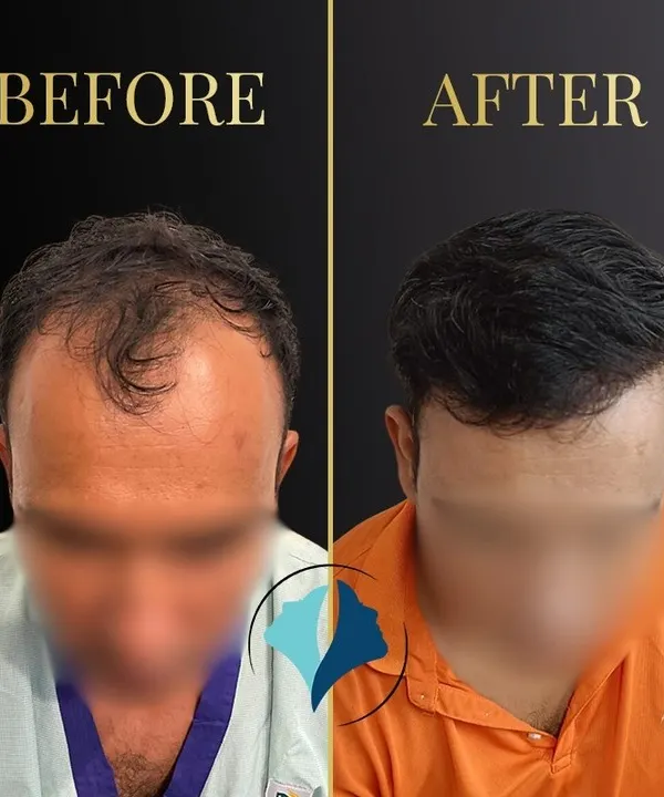 A clear comparison showing the result of our FUE hair transplant. We focus on creating a dense, natural-looking hairline that restores not just hair, but also confidence.