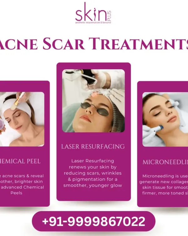 This graphic showcases my primary treatments for acne scars: Chemical Peels for revealing smoother skin, Laser Resurfacing for renewing skin, and Microneedling for generating new collagen and tissue.