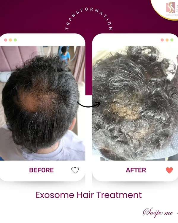 This is the kind of transformation that makes my work so rewarding. Using a science-backed Exosome treatment plan, we were able to significantly improve hair density and coverage for this client, addressing the thinning at the crown and restoring his confidence.