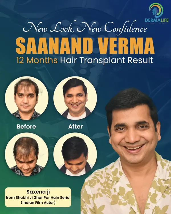 Here is the 12-month result for Saanand Verma, popularly known as Saxena Ji. We focused on creating a dense and age-appropriate hairline that completely revitalized his look.