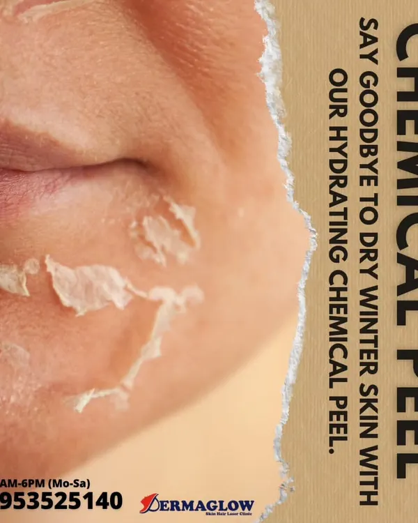This image shows the exfoliation process that occurs after a chemical peel. This shedding of the outer, damaged layer of skin is a natural part of the renewal process, revealing the fresh, smooth, and hydrated skin underneath.