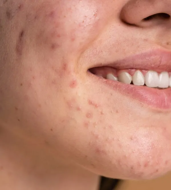 This image shows common atrophic acne scars, which are depressions left after severe acne. My treatment for such scars focuses on rebuilding collagen from within using procedures like microneedling or fractional lasers to gradually improve skin texture and smoothness.