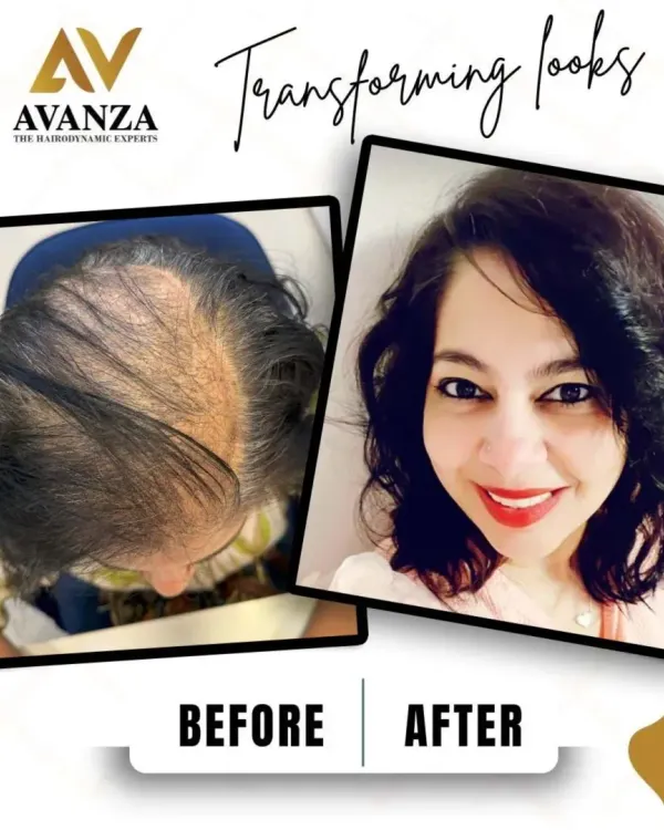 This is the kind of transformation that brings back confidence. We helped this client address significant hair thinning on her crown, resulting in fuller, healthier, and natural-looking hair that she is proud of.