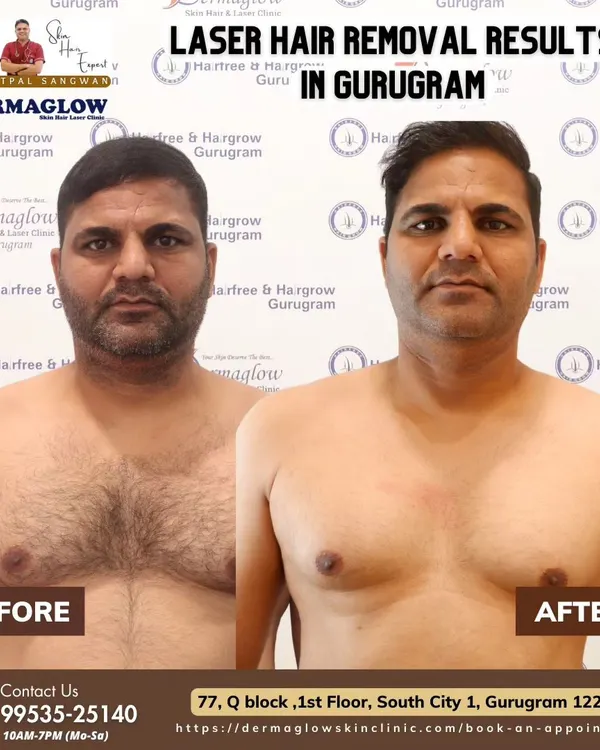 This is the result our clients come for. The image on the left shows the chest area before treatment, and the image on the right shows the smooth, clear skin after completing the laser hair removal sessions. We achieve permanent hair reduction for a clean and confident look.