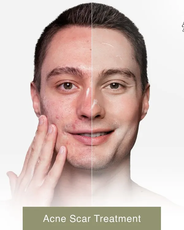 This before and after comparison shows the power of targeted acne scar treatment. We can significantly reduce the appearance of scars, leading to smoother and clearer skin.