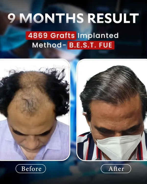 This is the result of our B.E.S.T. FUE method after nine months. We successfully implanted 4869 grafts to restore a natural, dense hairline and provide significant coverage for this patient, demonstrating a complete and life changing hair transformation.