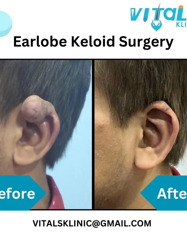 This powerful before-and-after shows the result of an earlobe keloid surgery. The procedure involved careful surgical removal of the excessive scar tissue to completely restore the ear's natural shape.