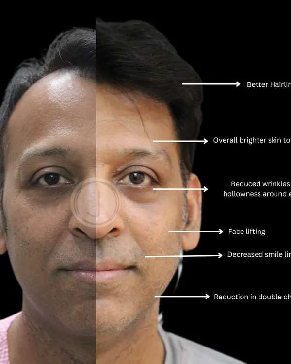 This is the result of a personalized treatment plan. We addressed not just the patient's hair thinning, which led to a stronger hairline, but also his skin concerns. A comprehensive approach ensures you look and feel your best.
