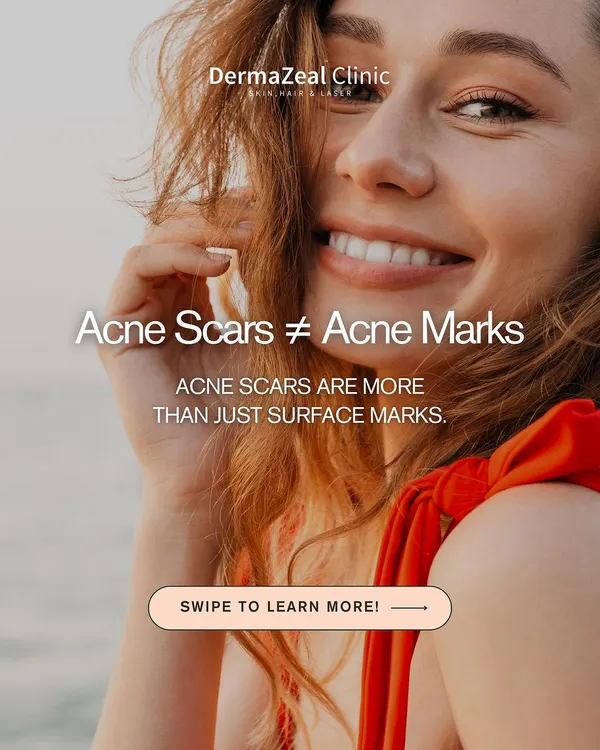 It's important to know that acne scars are not the same as acne marks. Scars involve damage to the deeper layers of the skin and require specific treatments to improve.
