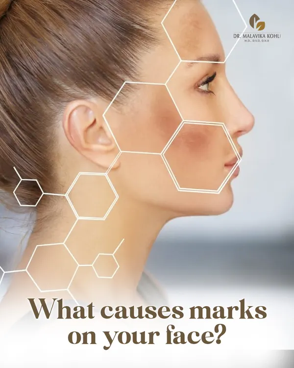 Facial marks and discoloration can stem from a variety of underlying conditions. Understanding the specific cause, whether it is post-inflammatory hyperpigmentation, melasma, or another issue, is the first step toward creating an effective treatment plan.