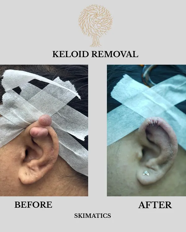This before and after image shows a successful keloid removal from the ear. Keloids are raised scars that can form after minor skin trauma. We use specialized techniques to remove the scar tissue and help restore a smoother skin surface.