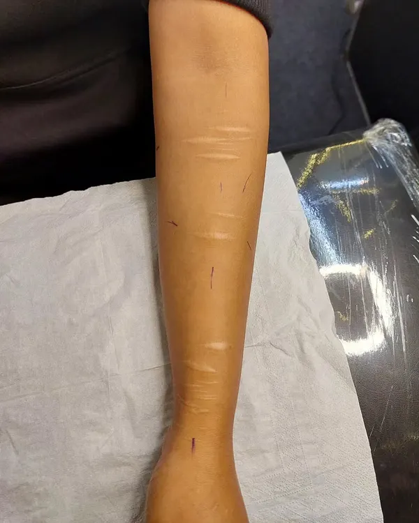 Before: This image shows the client's forearm with visible self-harm scars before the cover-up process.