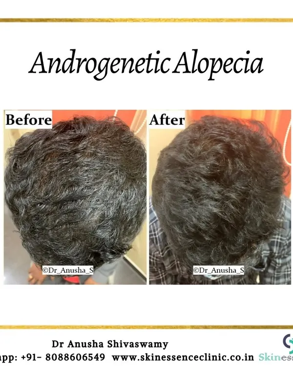 This top-down view clearly shows the successful treatment of androgenetic alopecia. The patient's hair appears significantly fuller and the scalp is less visible after a course of customized medical therapy.