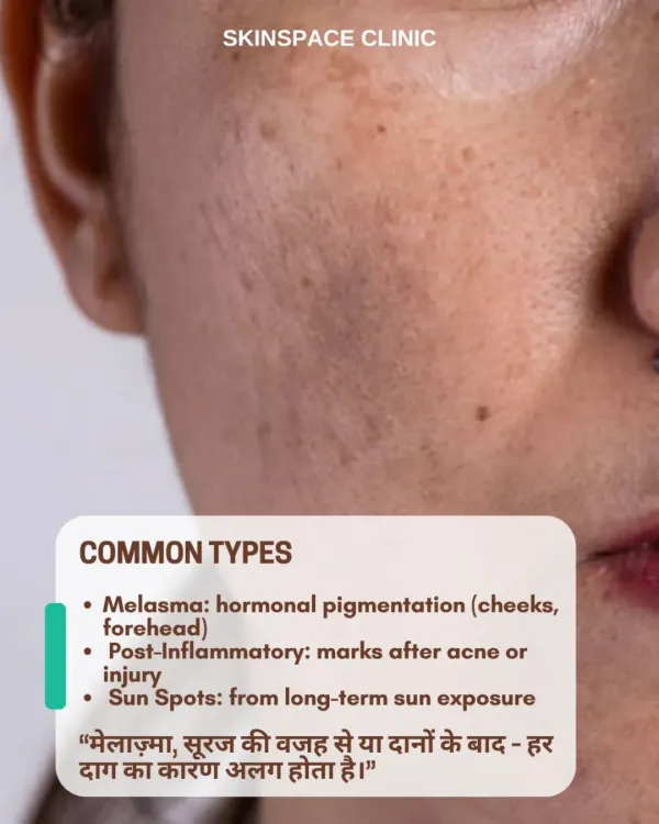 Pigmentation comes in many forms. It can be hormonal melasma, post-inflammatory marks left after acne, or sun spots from long-term sun exposure. Understanding the cause is key to effective treatment.